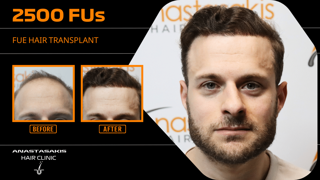 Anastasakis Hair Clinic