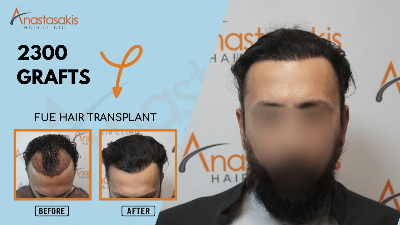 Anastasakis Hair Clinic