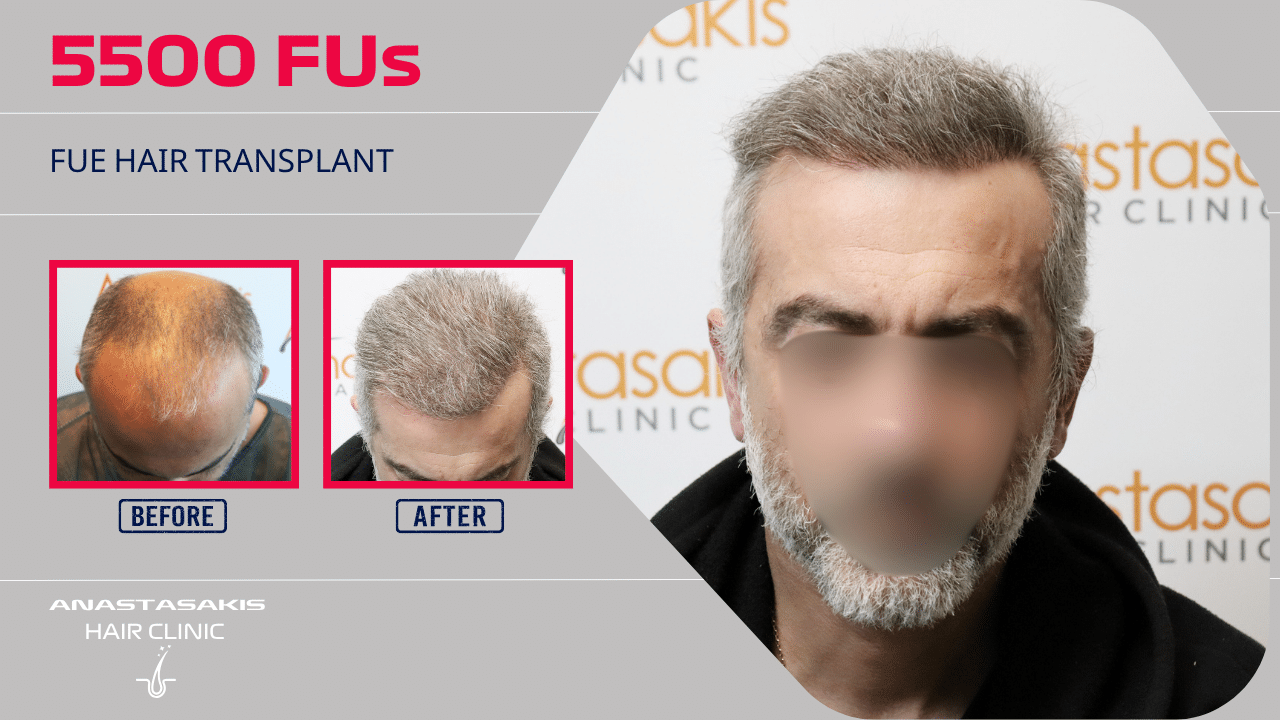 Anastasakis Hair Clinic