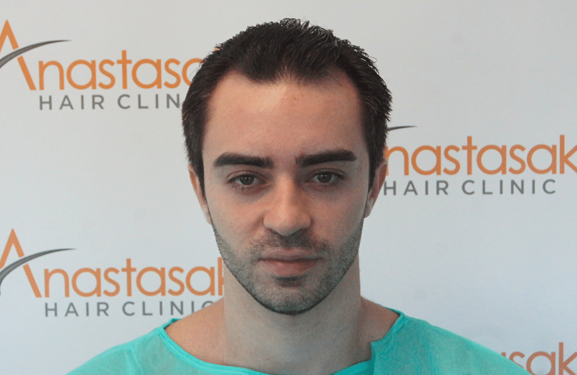 hair transplant result