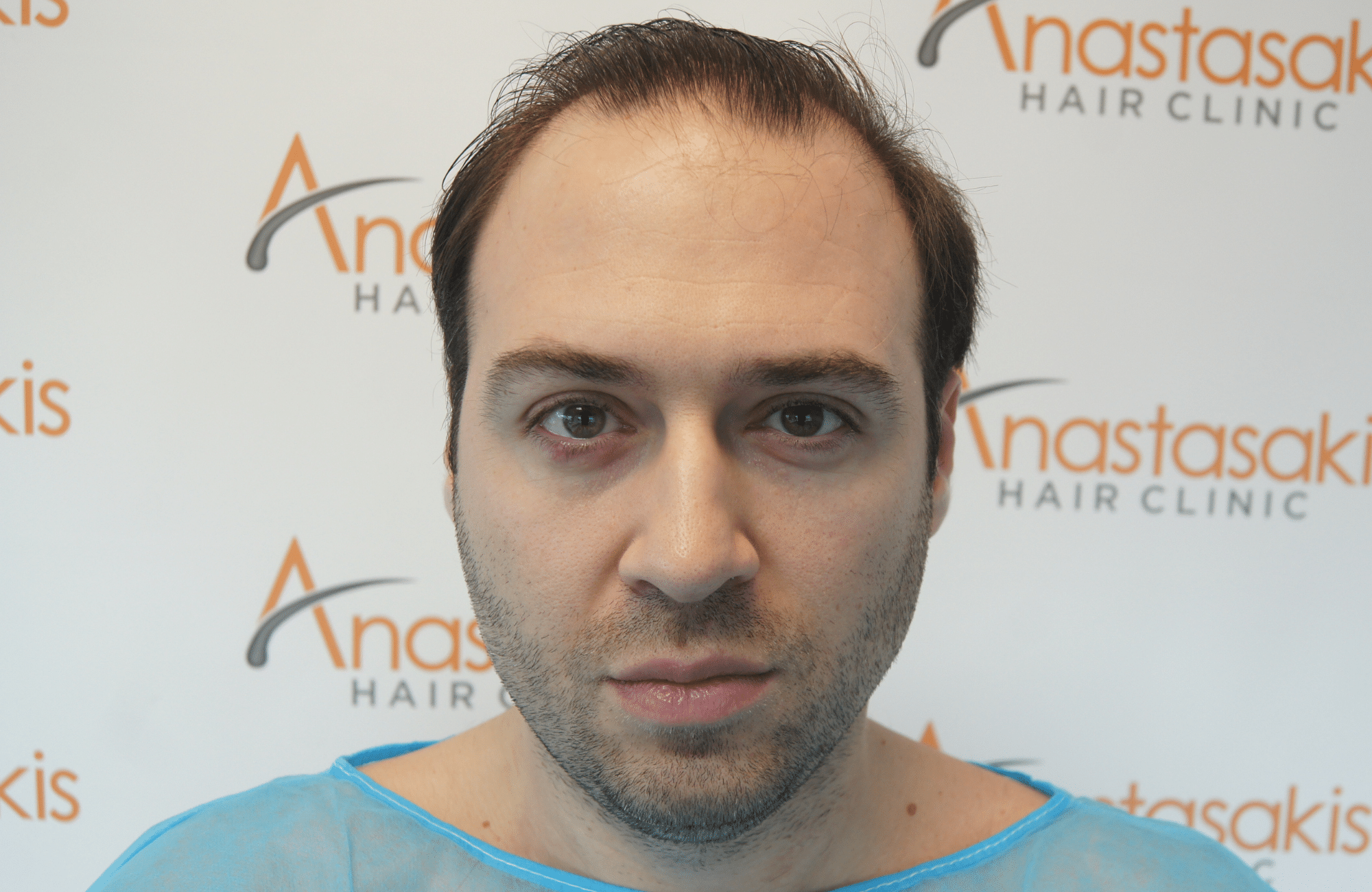 hair transplant result with 3500 follicular units anastasakis hair clinic fullface before