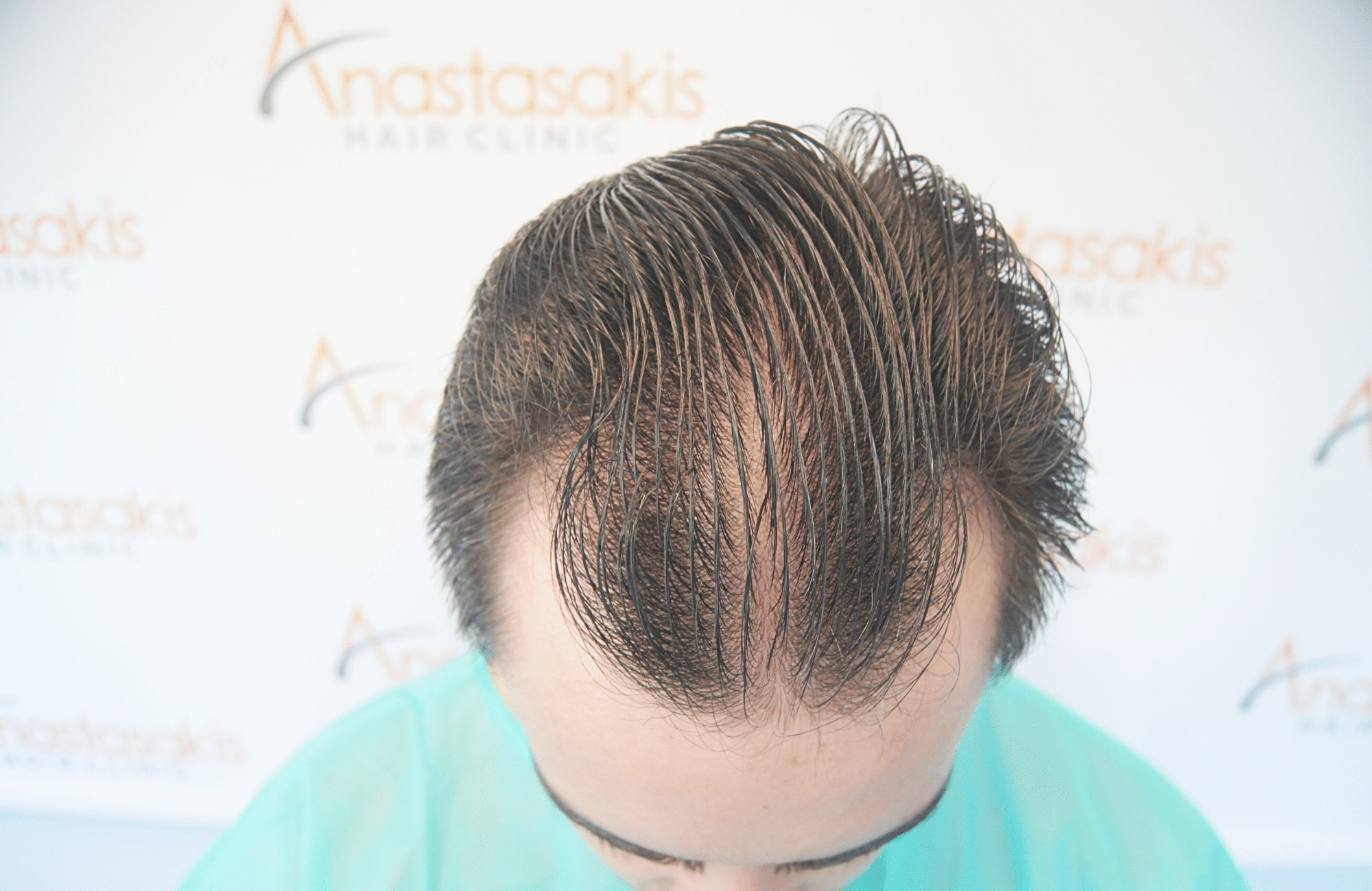 hair transplant result