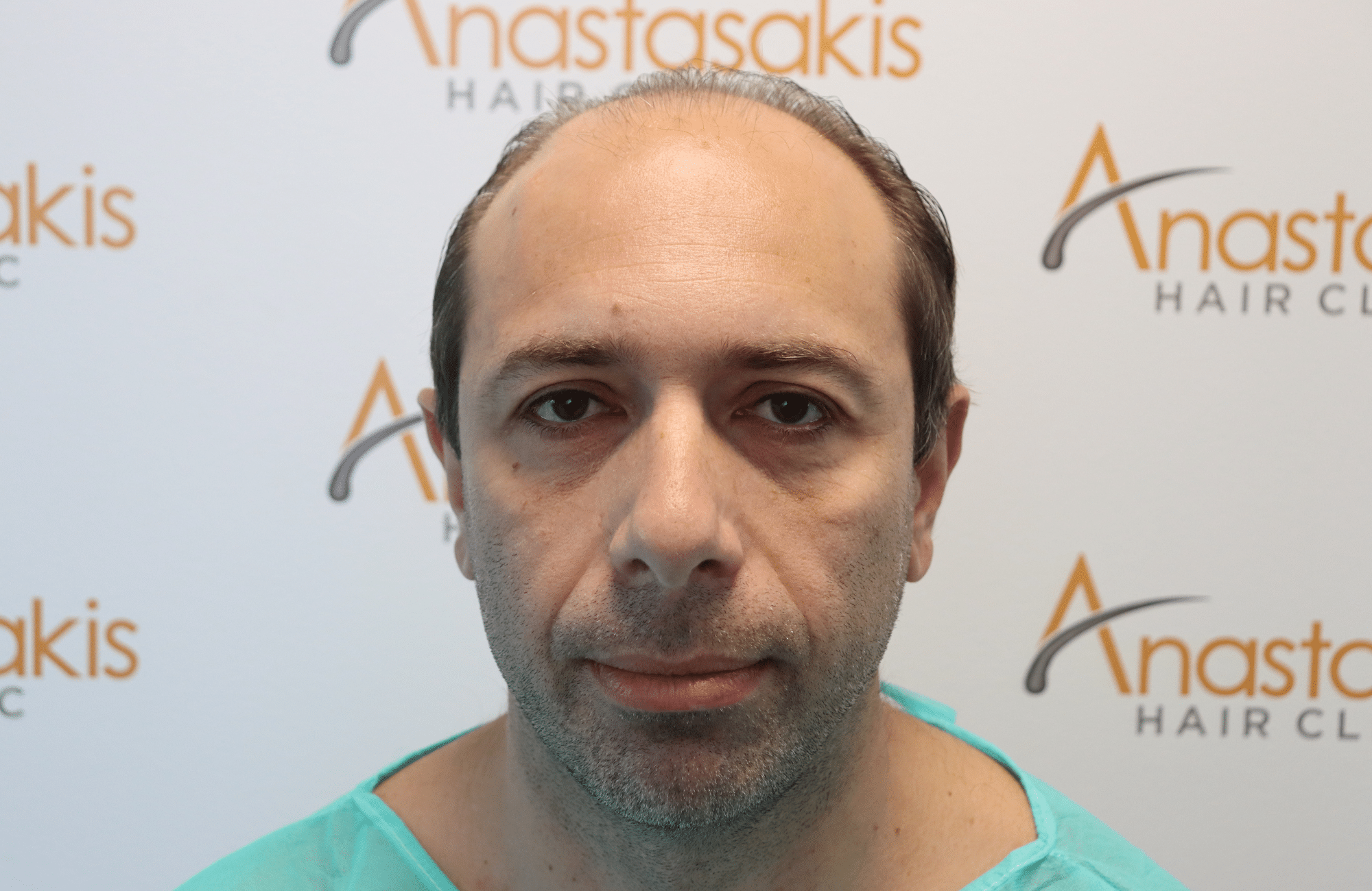 hair transplant 2600 fus