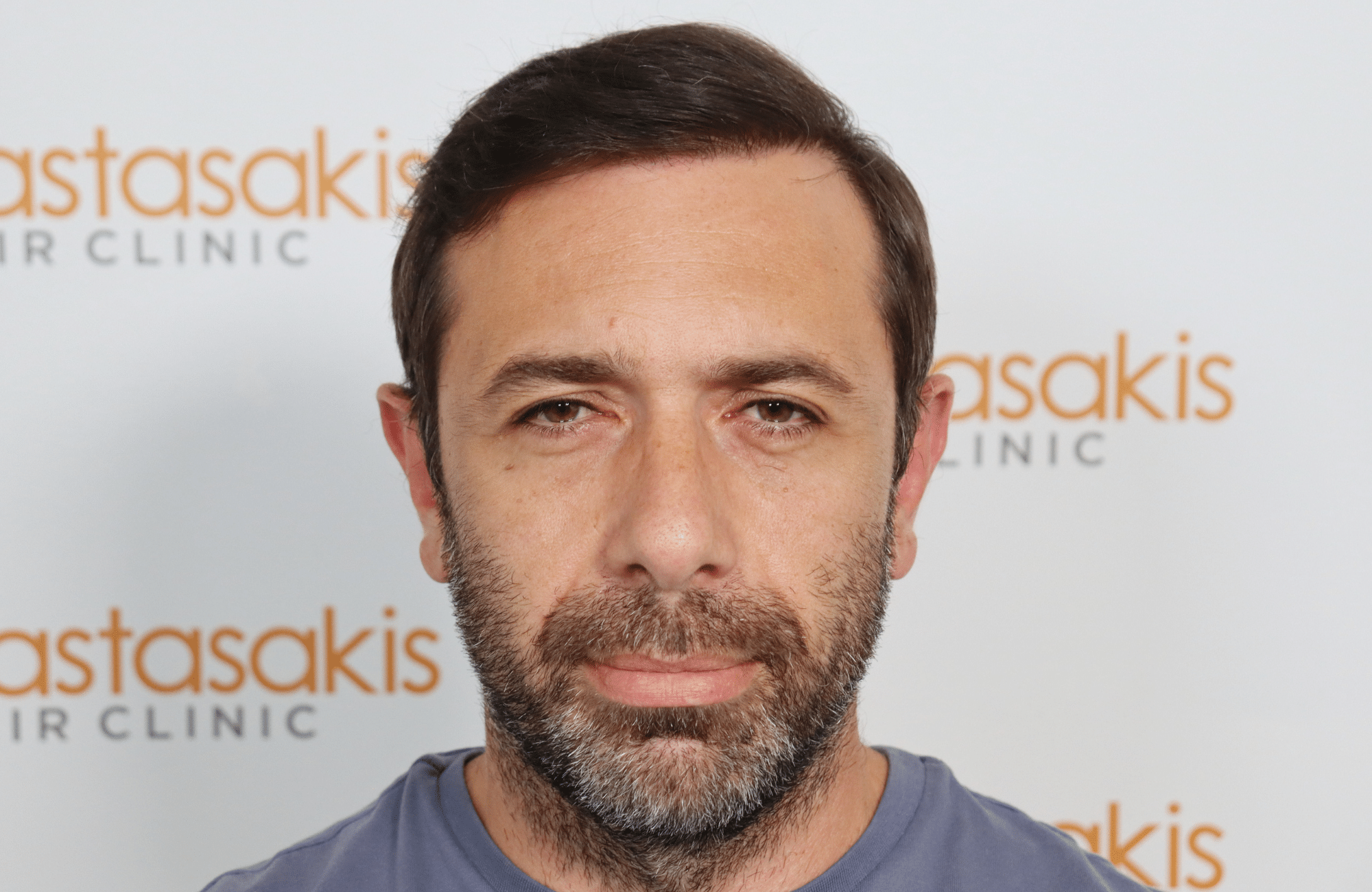 hair transplant 2600 fus