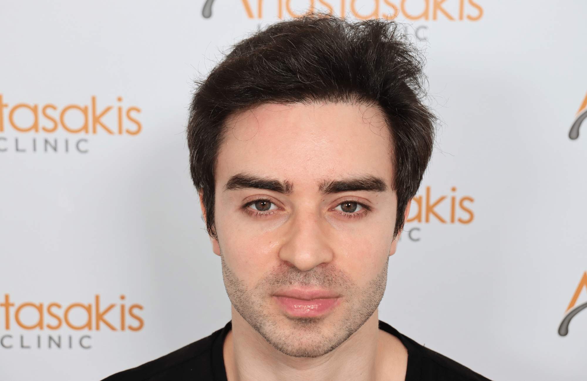 hair transplant result