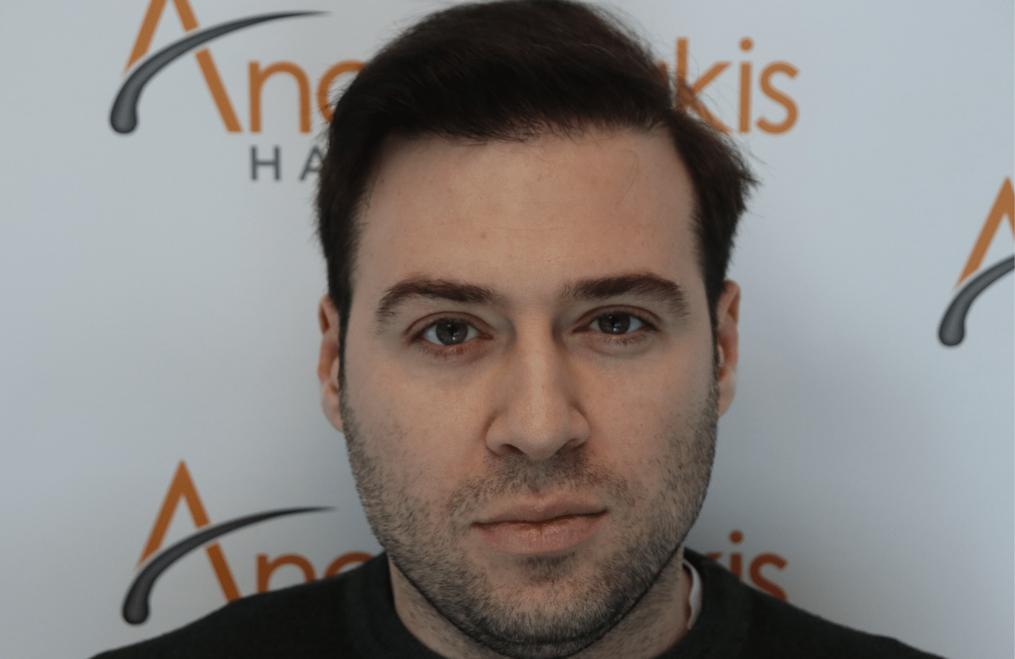 hair transplant result with 3500 follicular units anastasakis hair clinic fullface after