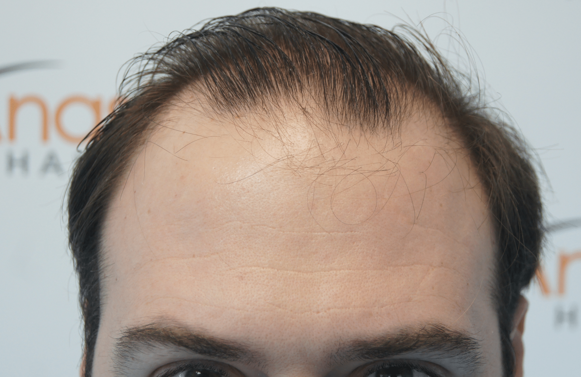 hair transplant result with 3500 follicular units anastasakis hair clinic hairine before