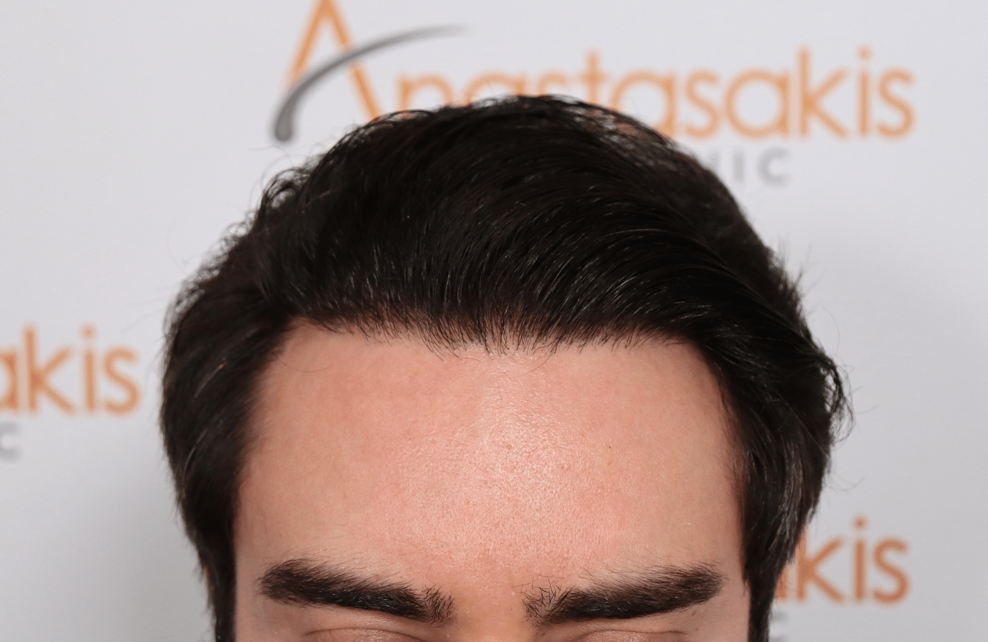 hair transplant result