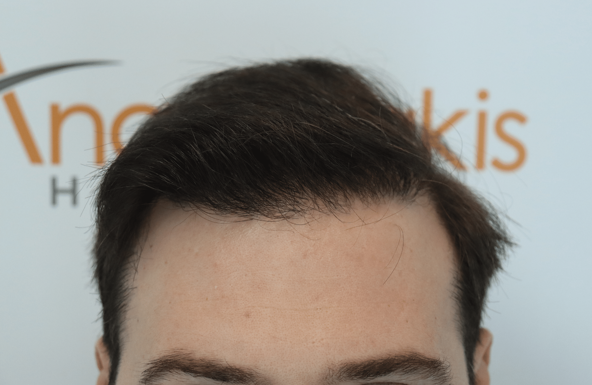 hair transplant result with 3500 follicular units anastasakis hair clinic hairine after