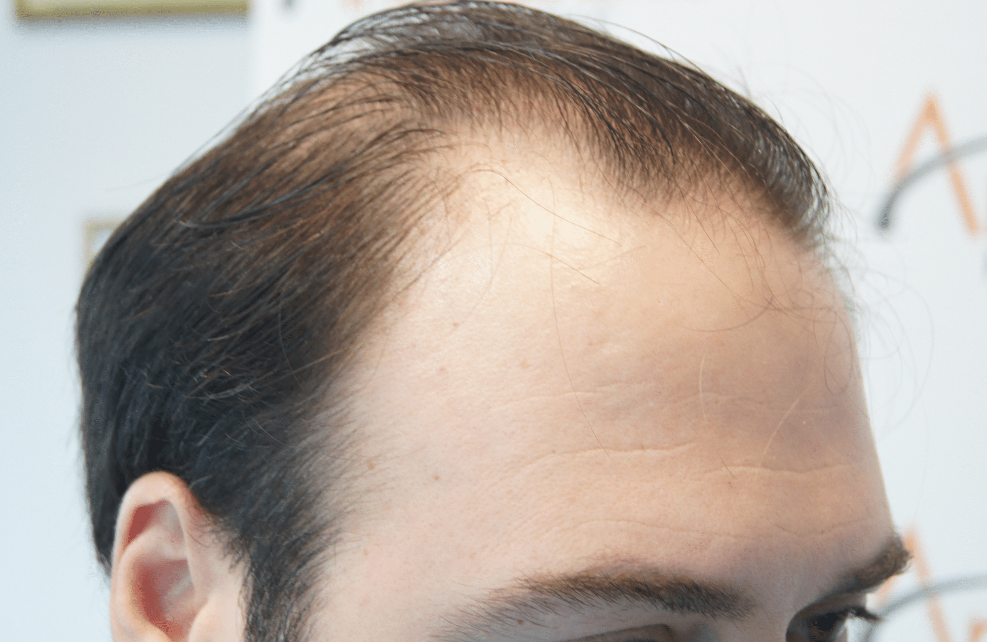 hair transplant result with 3500 follicular units anastasakis hair clinic side1 before