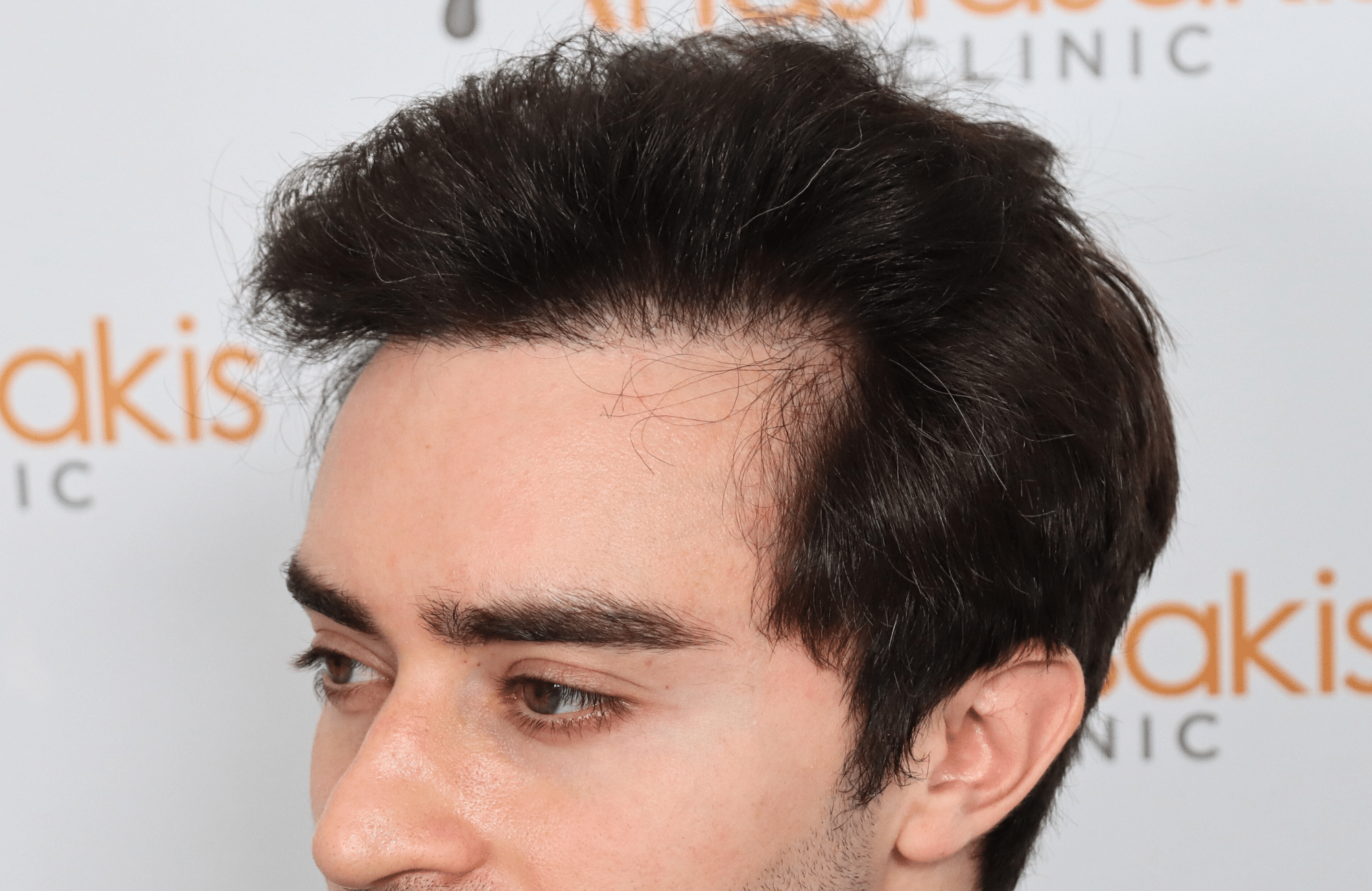 hair transplant result