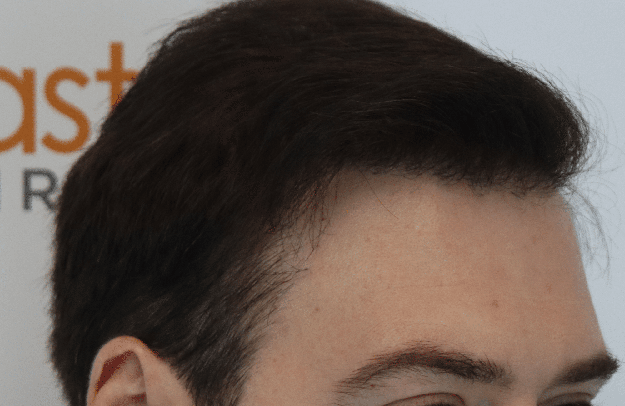 hair transplant result with 3500 follicular units anastasakis hair clinic side1 after