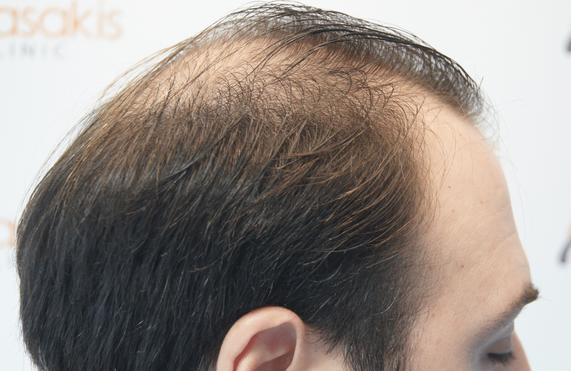 hair transplant result with 3500 follicular units anastasakis hair clinic side2 before