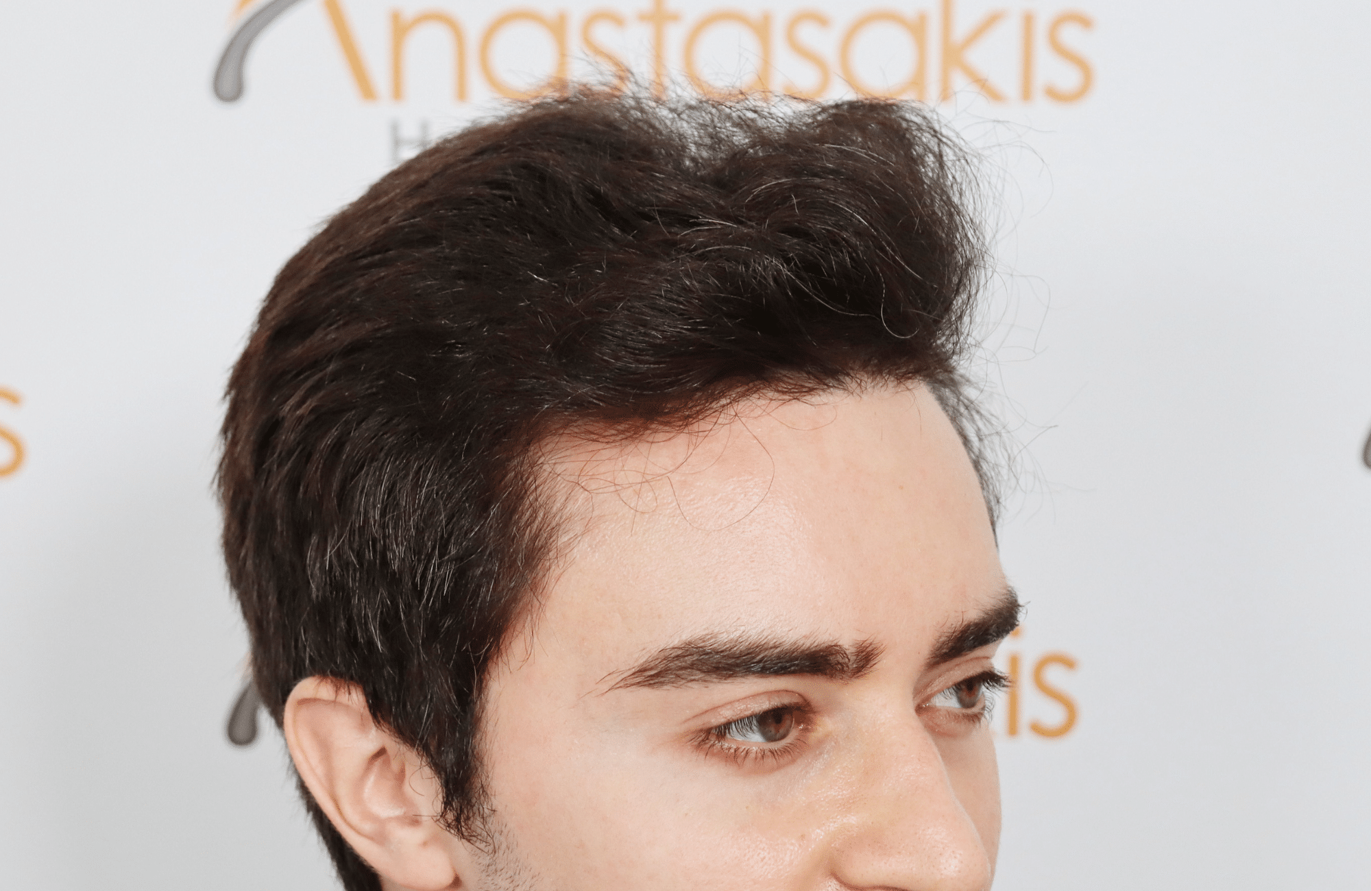 hair transplant result