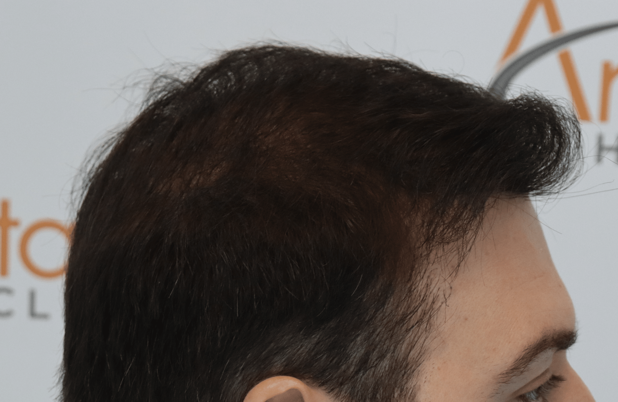 hair transplant result with 3500 follicular units anastasakis hair clinic side2 after