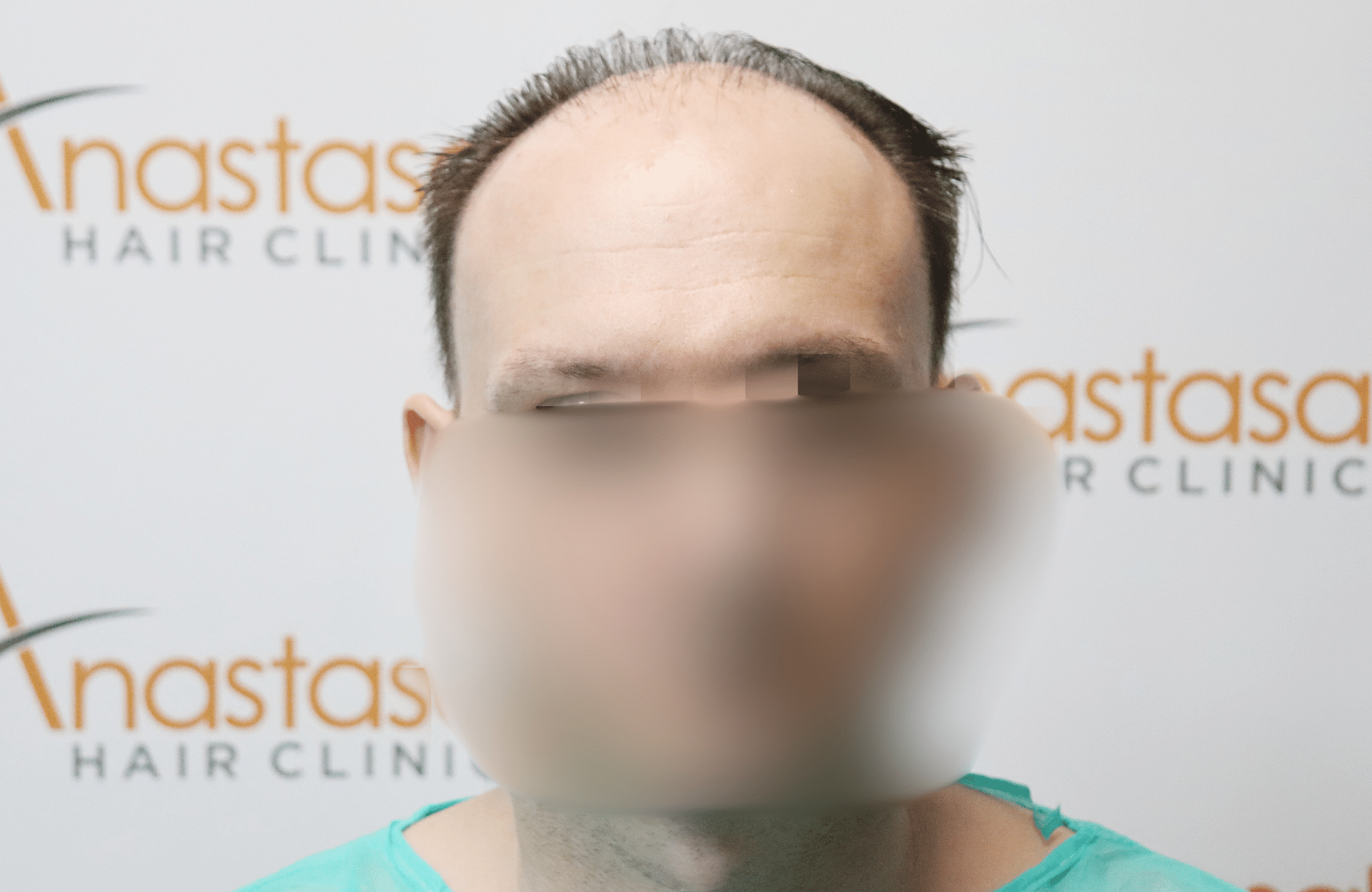 hair tranplant result (1)