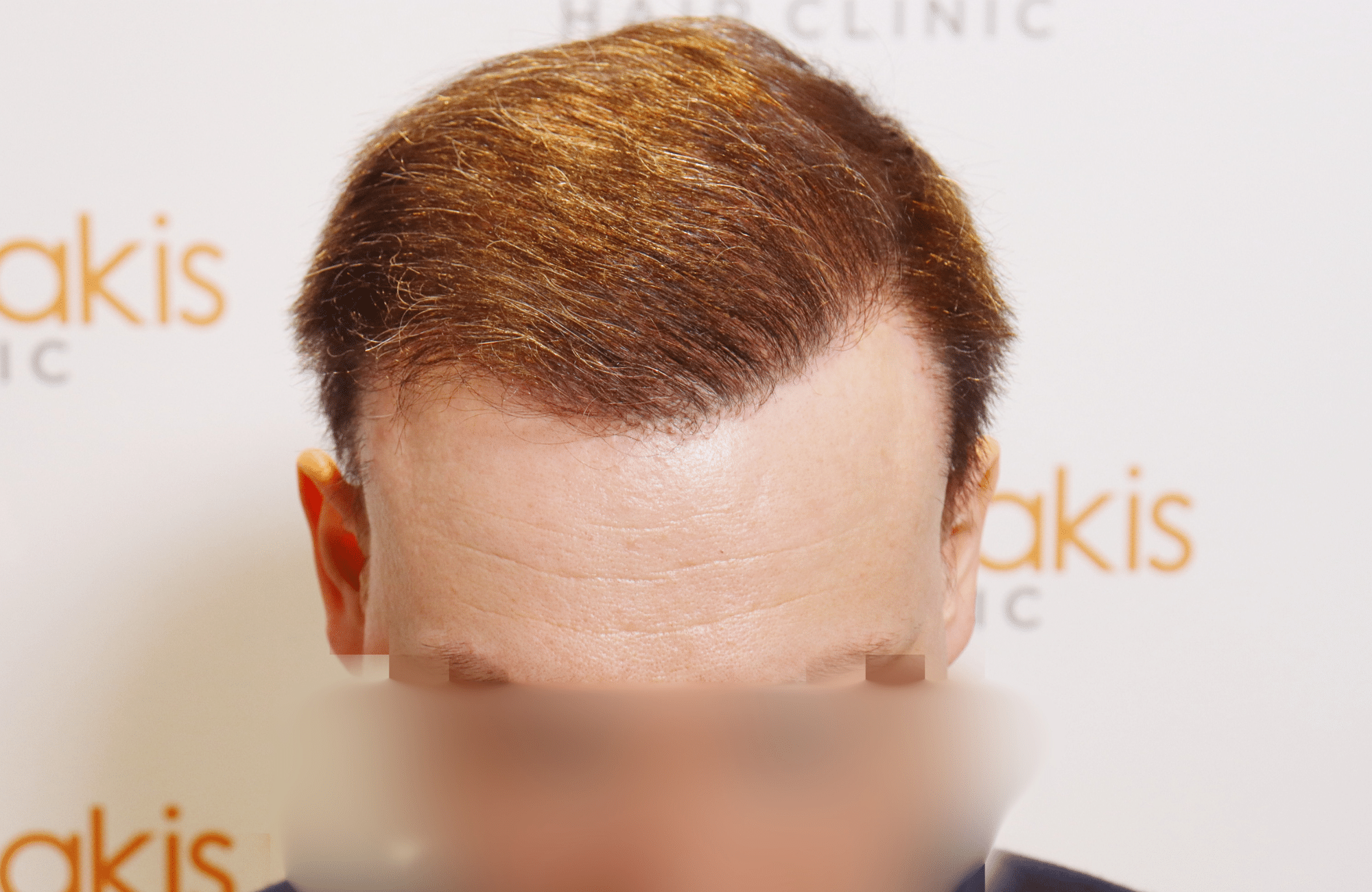 hair tranplant result (10)