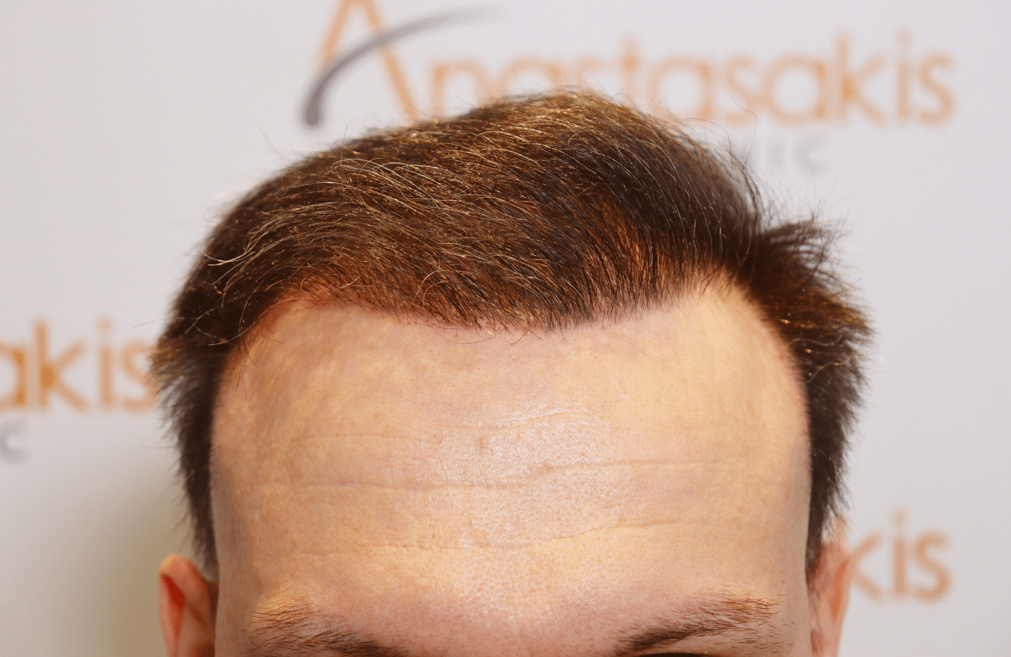 hair tranplant result (11)
