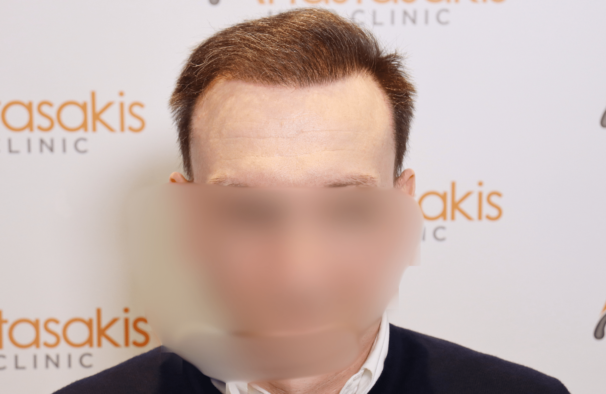 hair tranplant result (12)