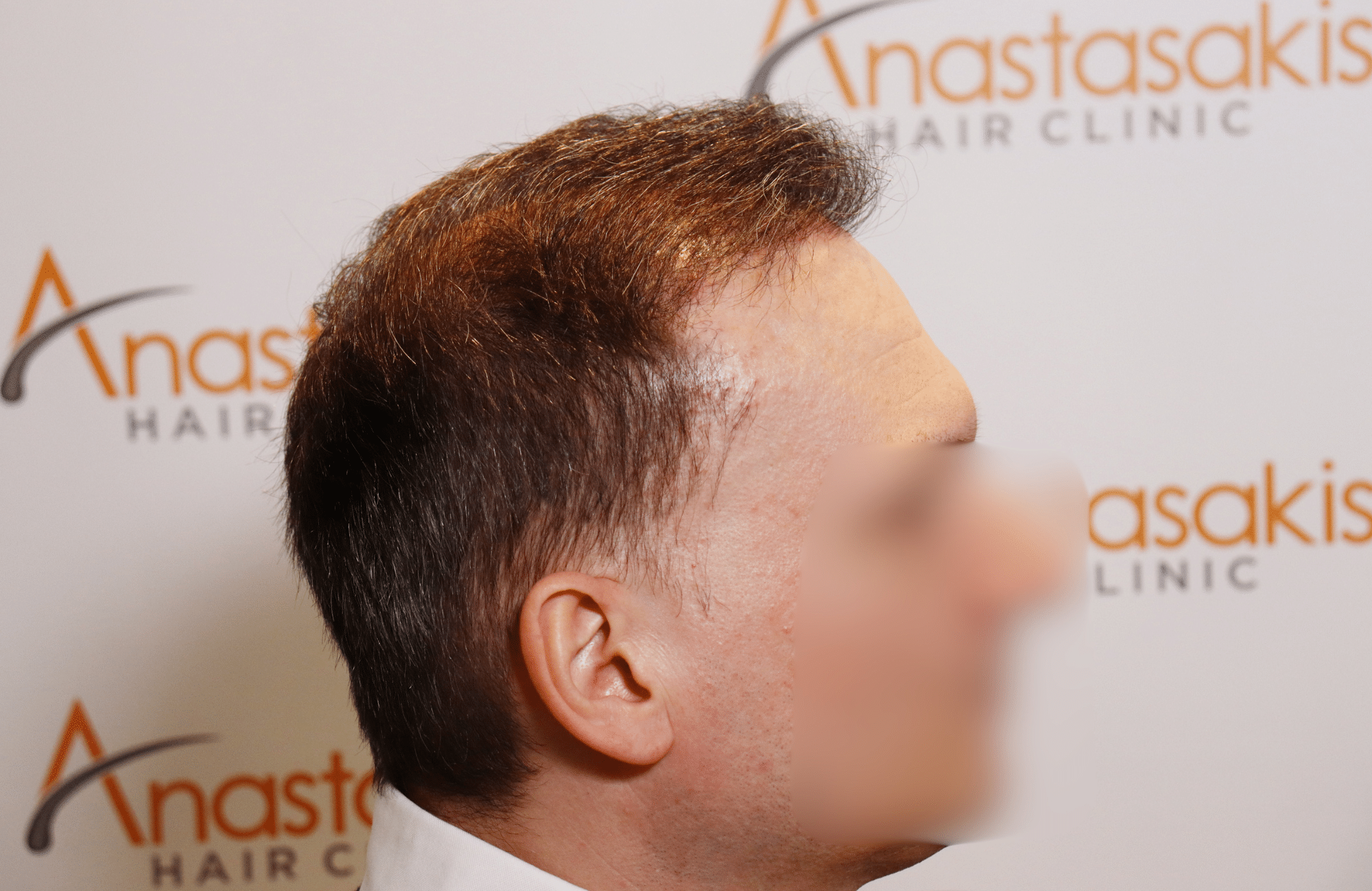 hair tranplant result (13)