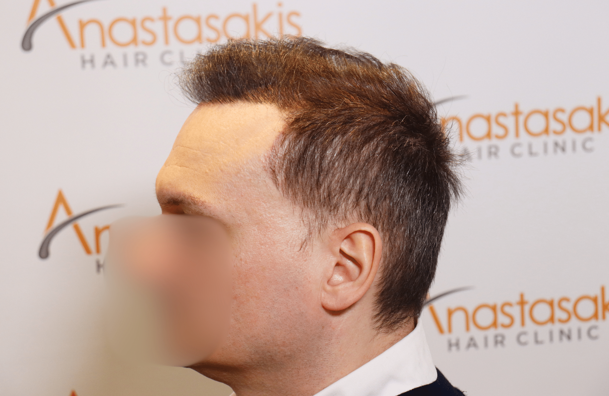 hair tranplant result (14)