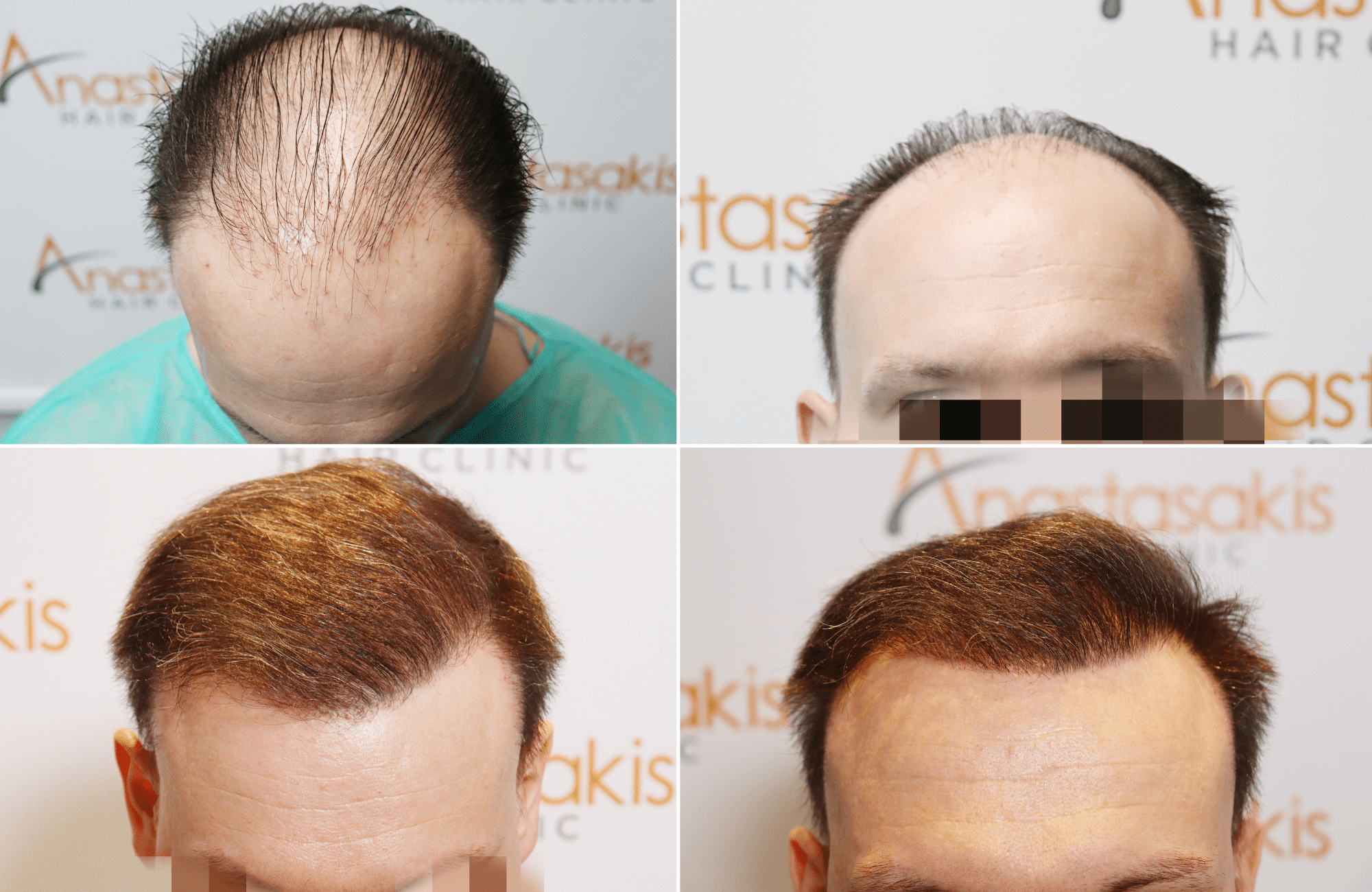 https://www.anastasakishairclinic.gr/portfolio/apotelesma-metamosxefsis-mallion-anastasakis-hair-clinic-18/