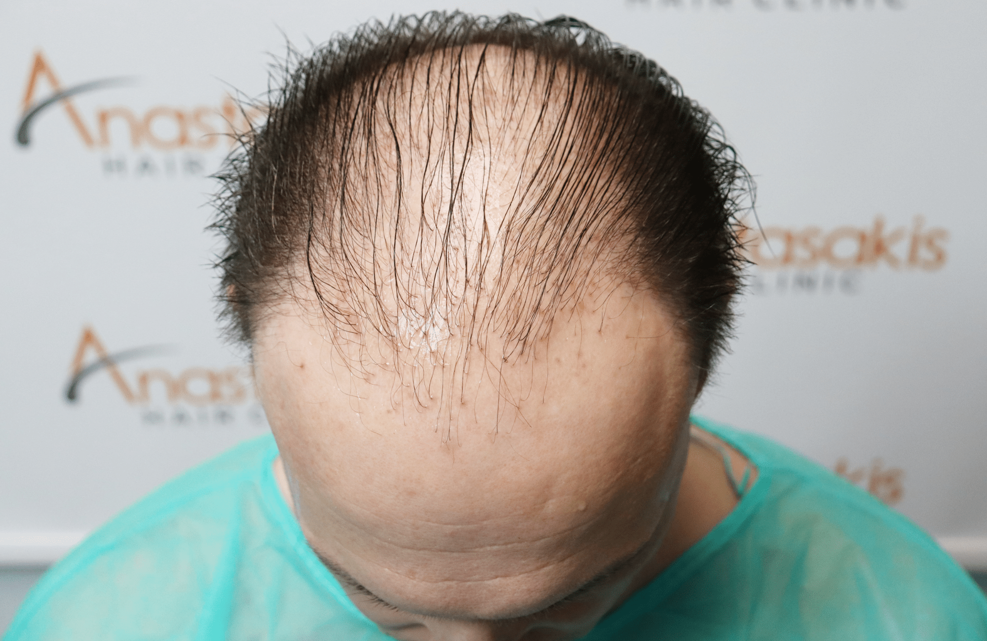 hair tranplant result (3)