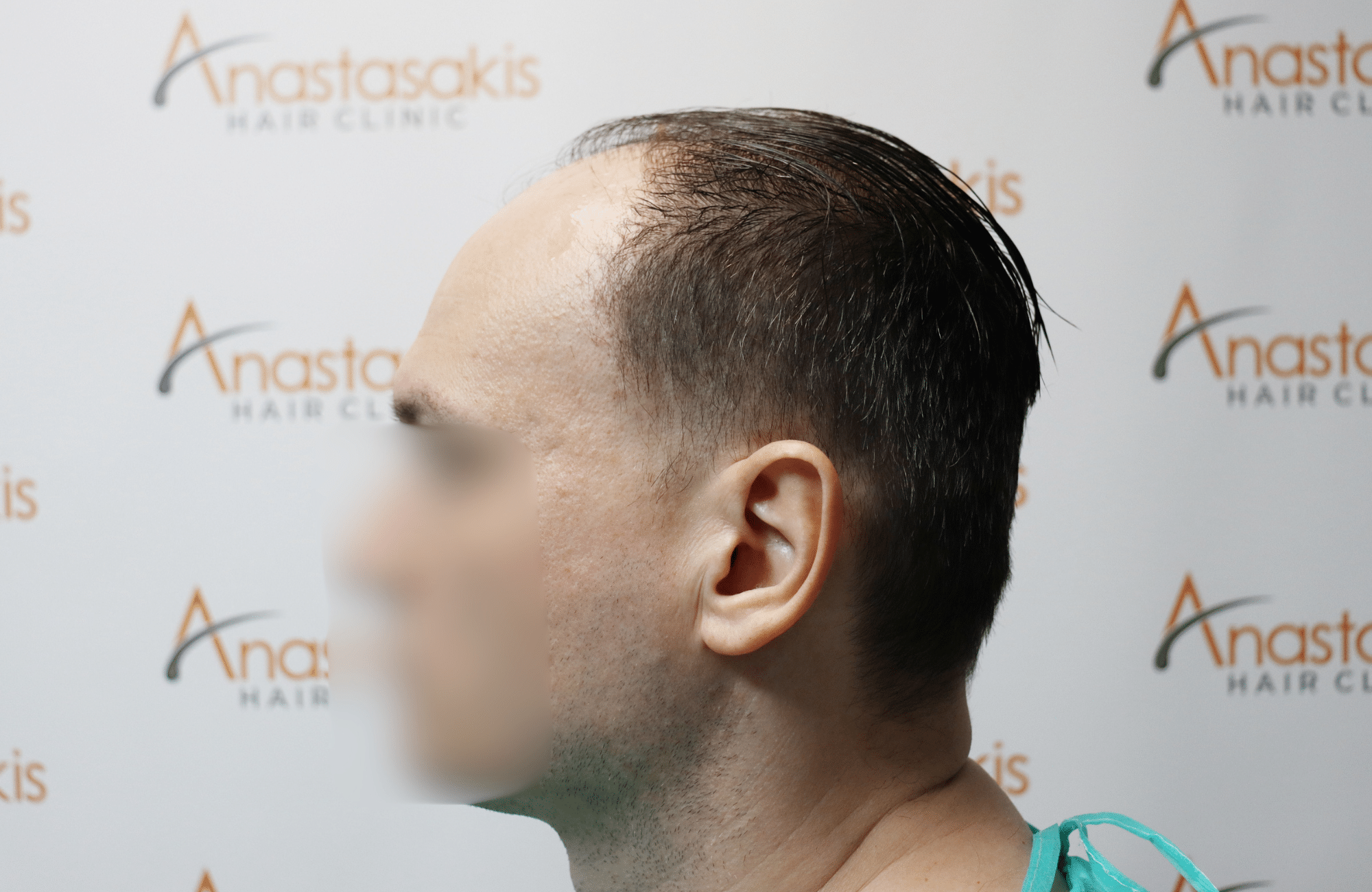 hair tranplant result (4)