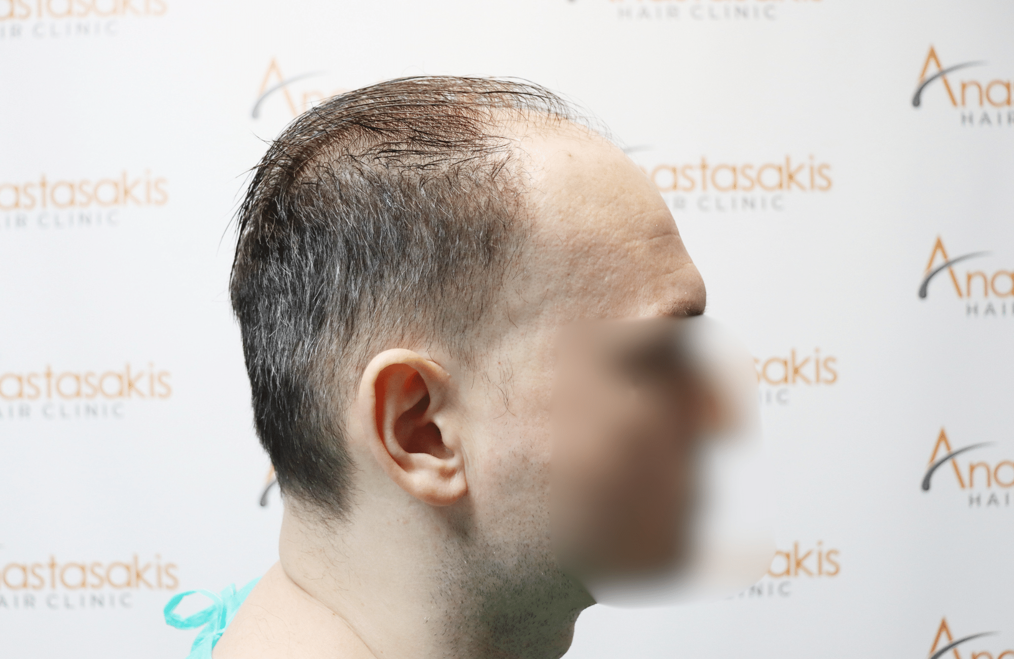 hair tranplant result (5)