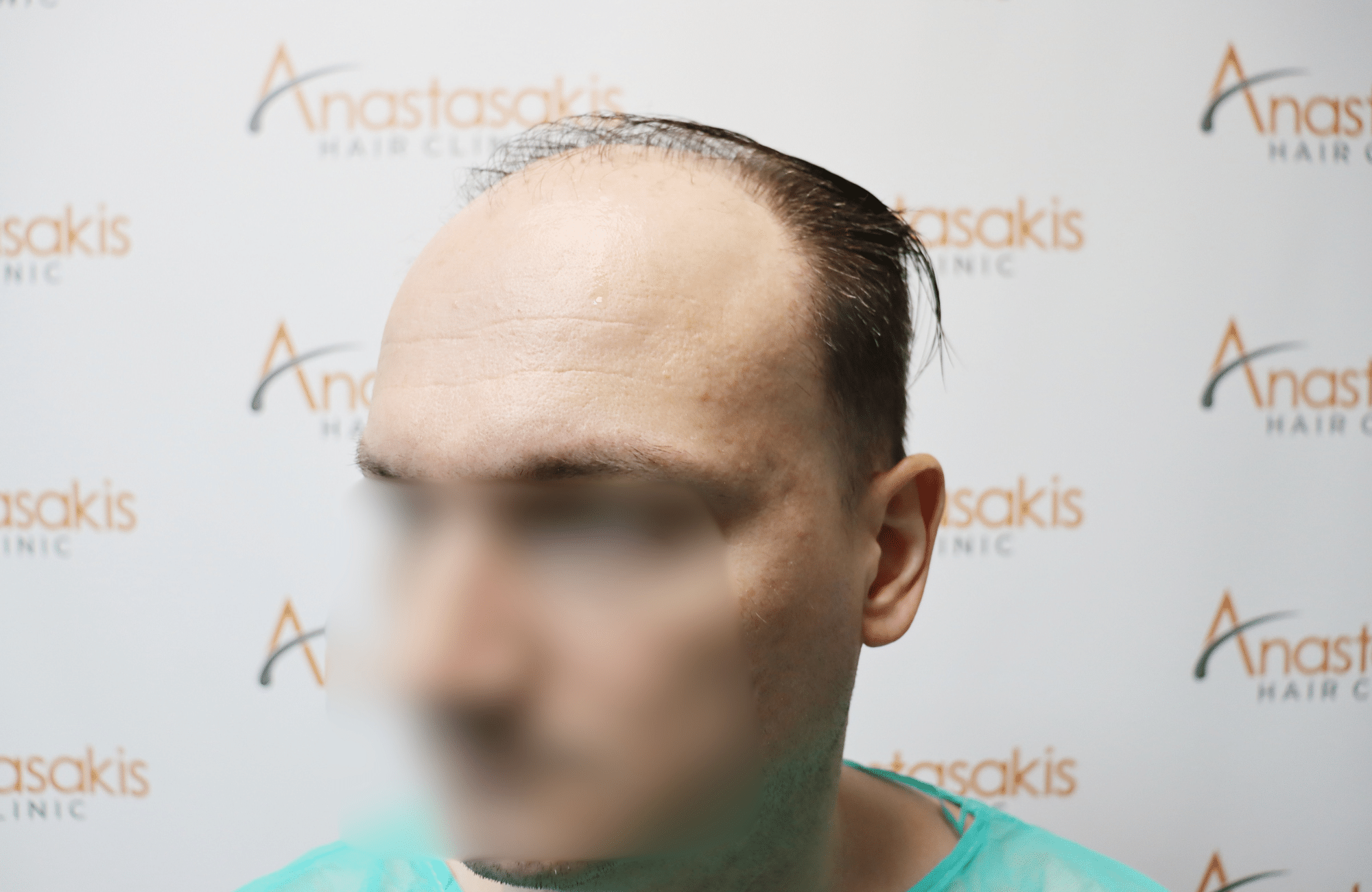 hair tranplant result (7)
