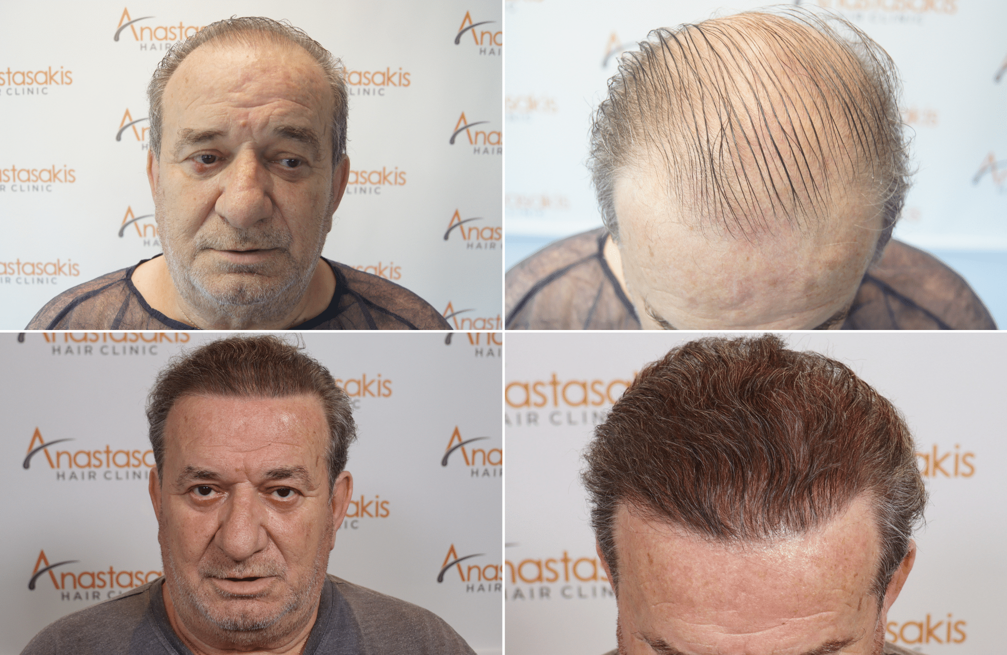 https://www.anastasakishairclinic.gr/portfolio/%ce%b1%cf%80%ce%bf%cf%84%ce%ad%ce%bb%ce%b5%cf%83%ce%bc%ce%b1-%ce%bc%ce%b5-3500-fus-562/