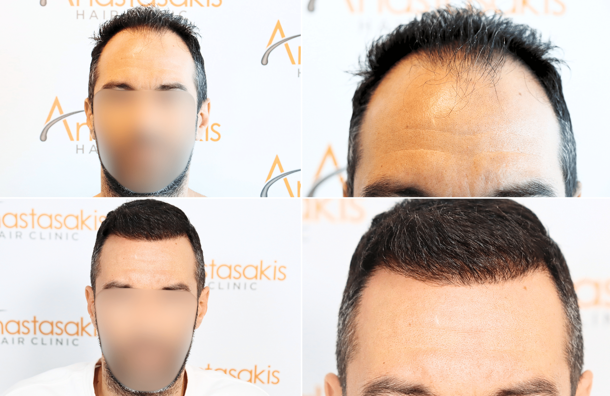 https://www.anastasakishairclinic.gr/portfolio/apotelesma-metamosxefsis-mallion-anastasakis-hair-clinic-403/