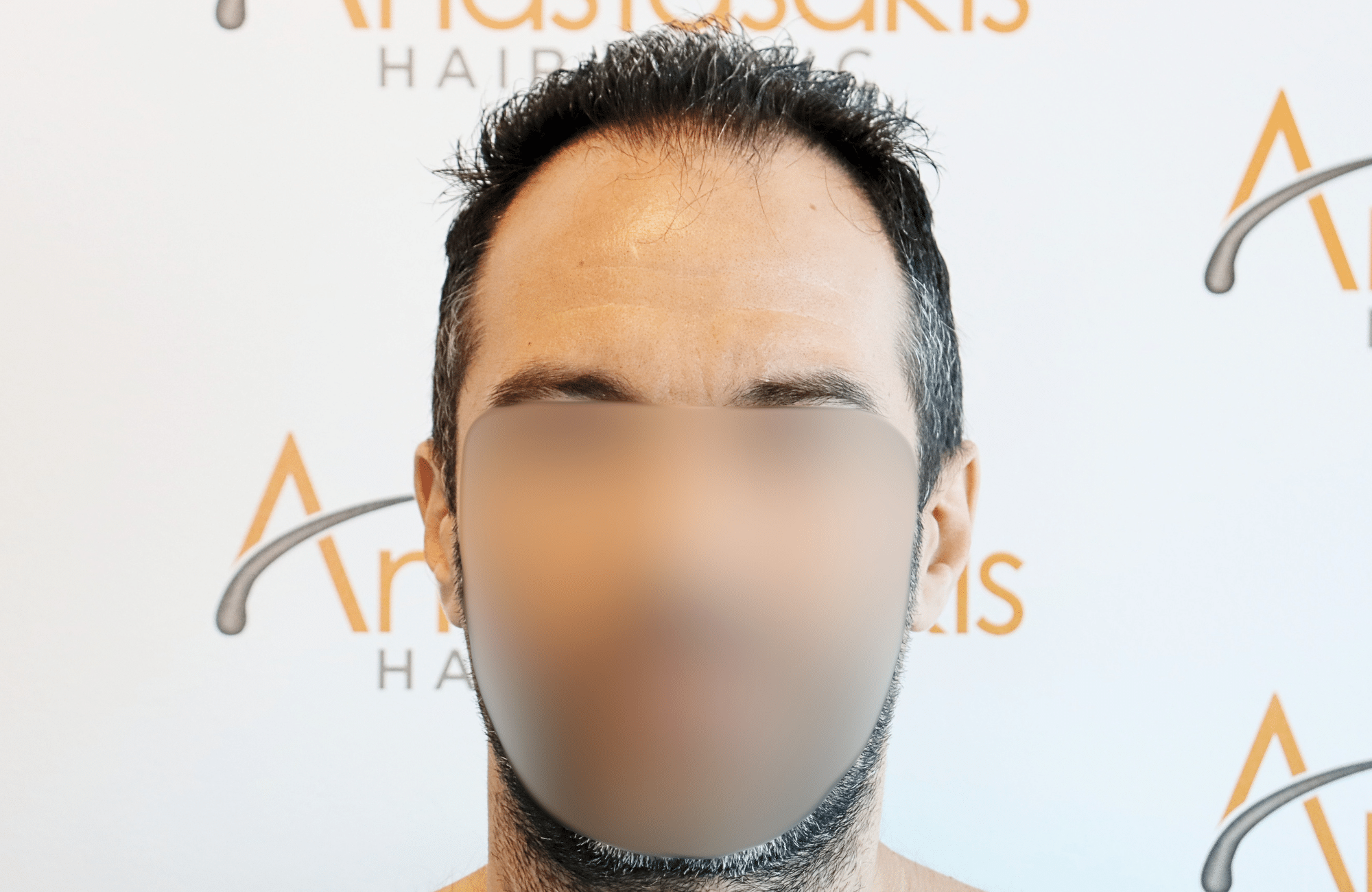 hair transplant result 2600 fus stage5 thickening