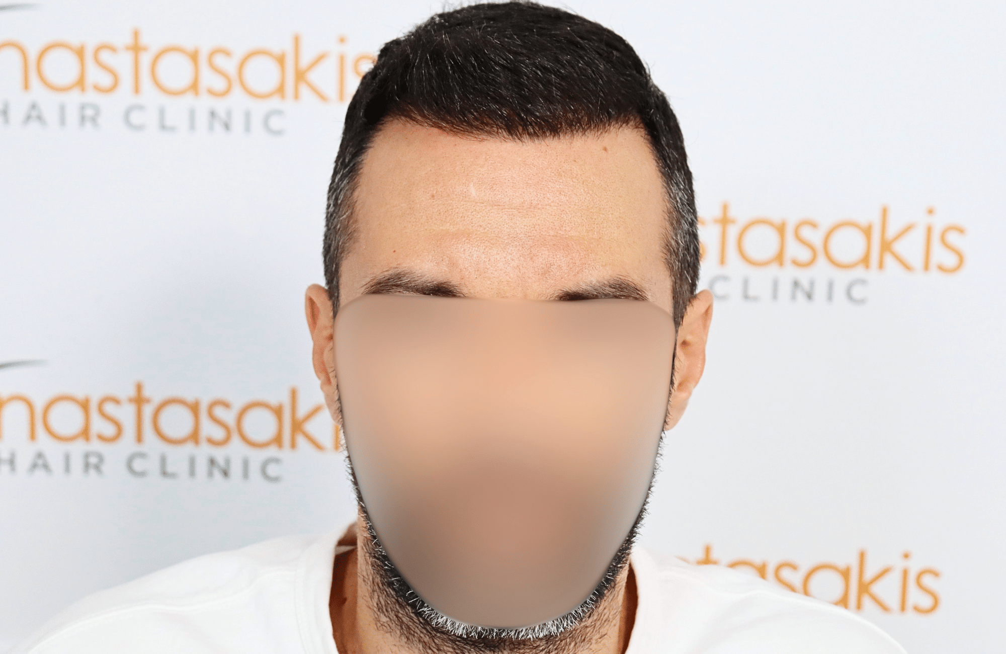 hair transplant result 2600 fus stage5 thickening
