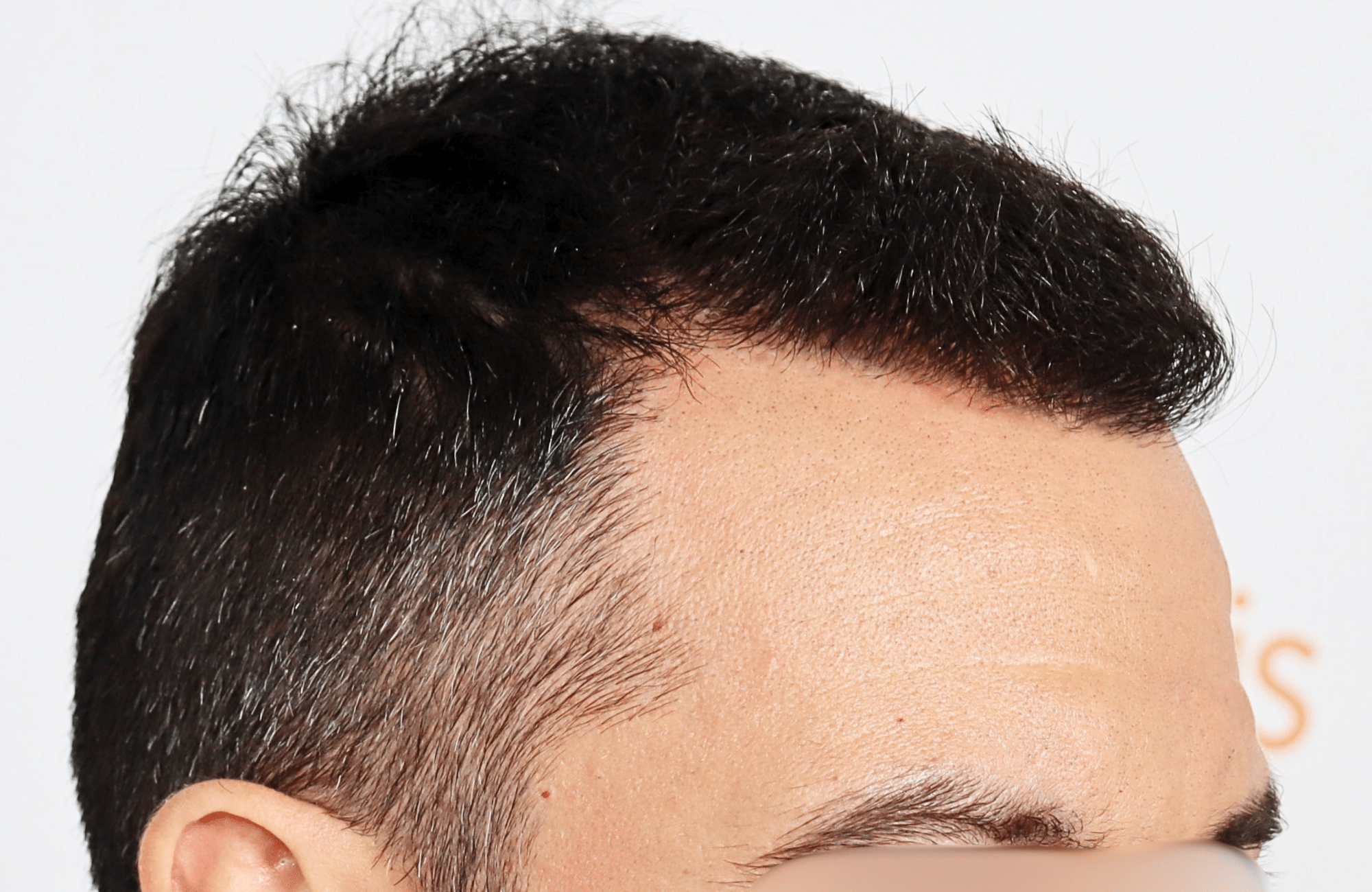 hair transplant result 2600 fus stage5 thickening