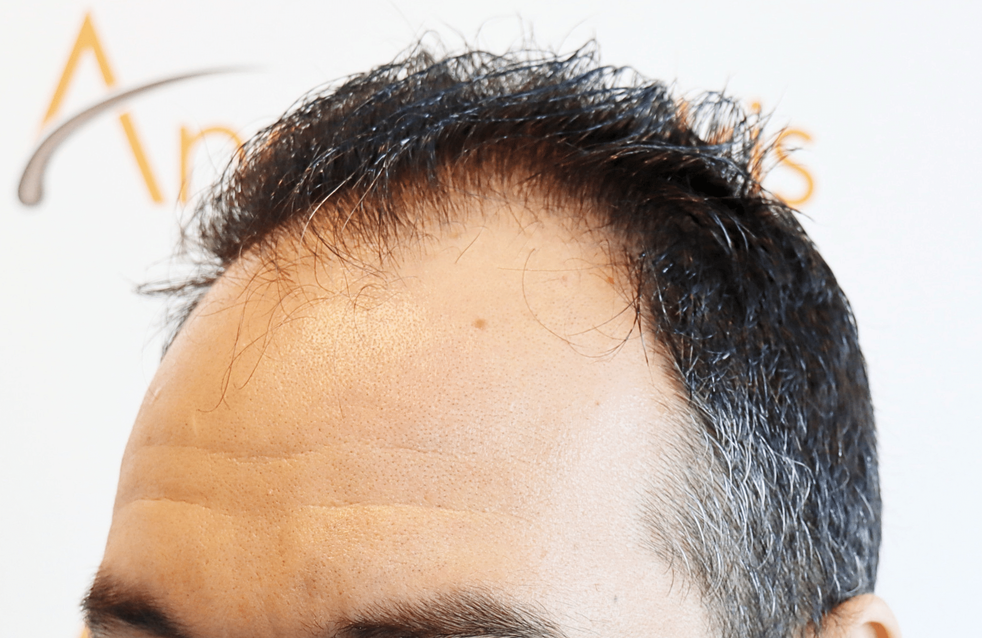 hair transplant result 2600 fus stage5 thickening