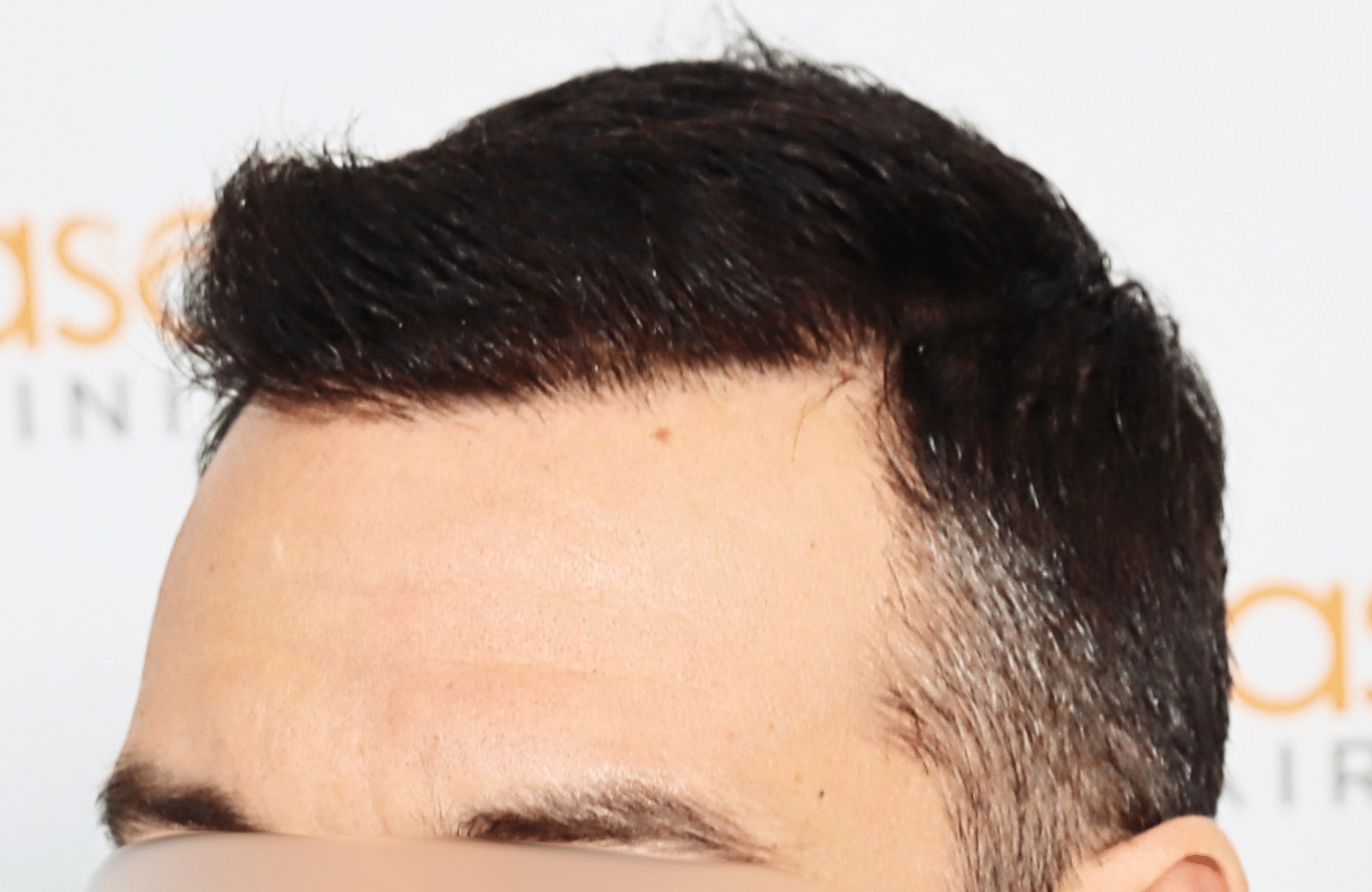 hair transplant result 2600 fus stage5 thickening
