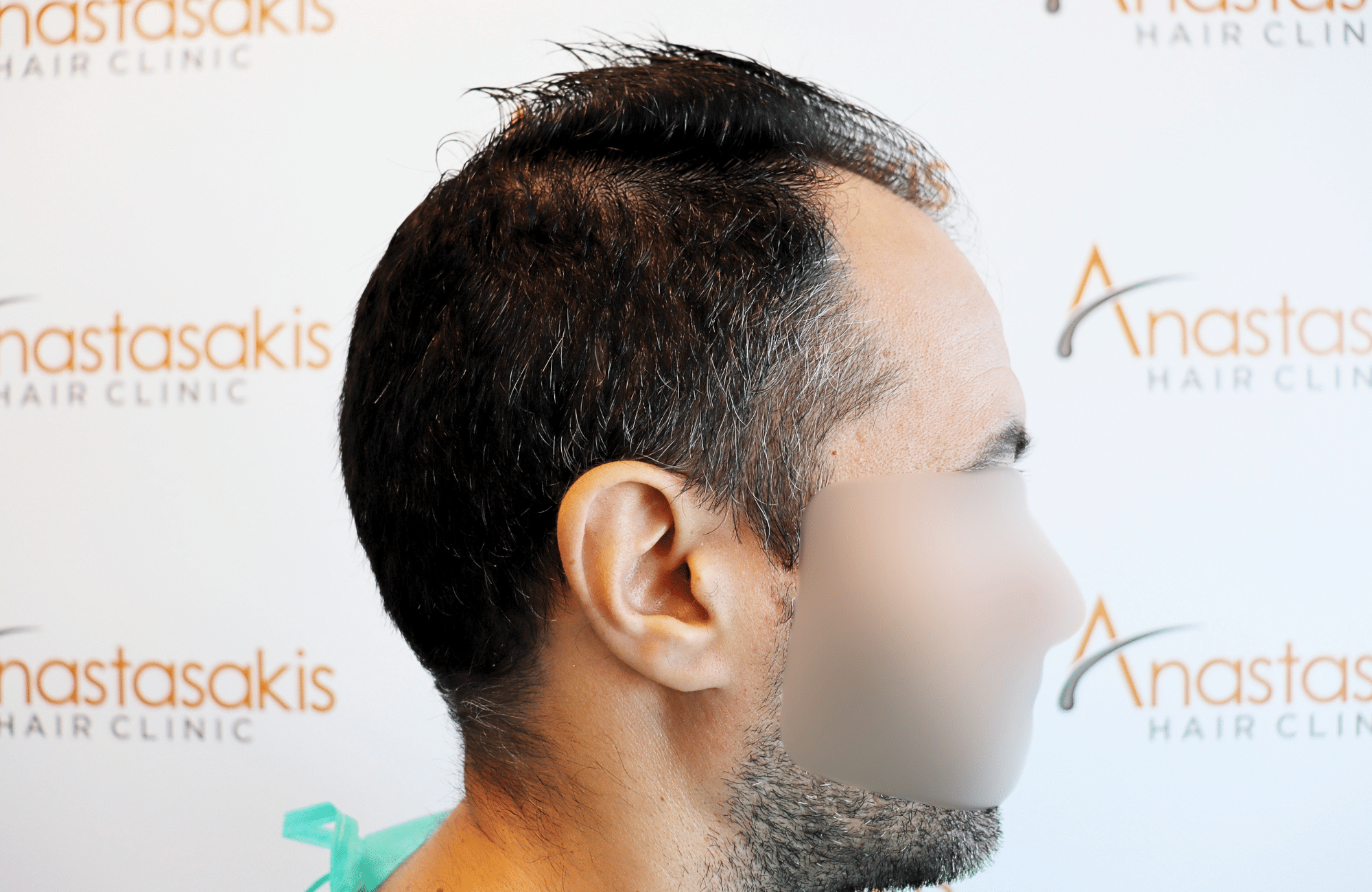 hair transplant result 2600 fus stage5 thickening