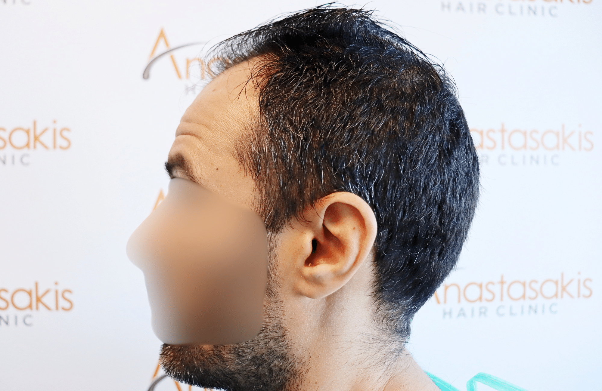hair transplant result 2600 fus stage5 thickening