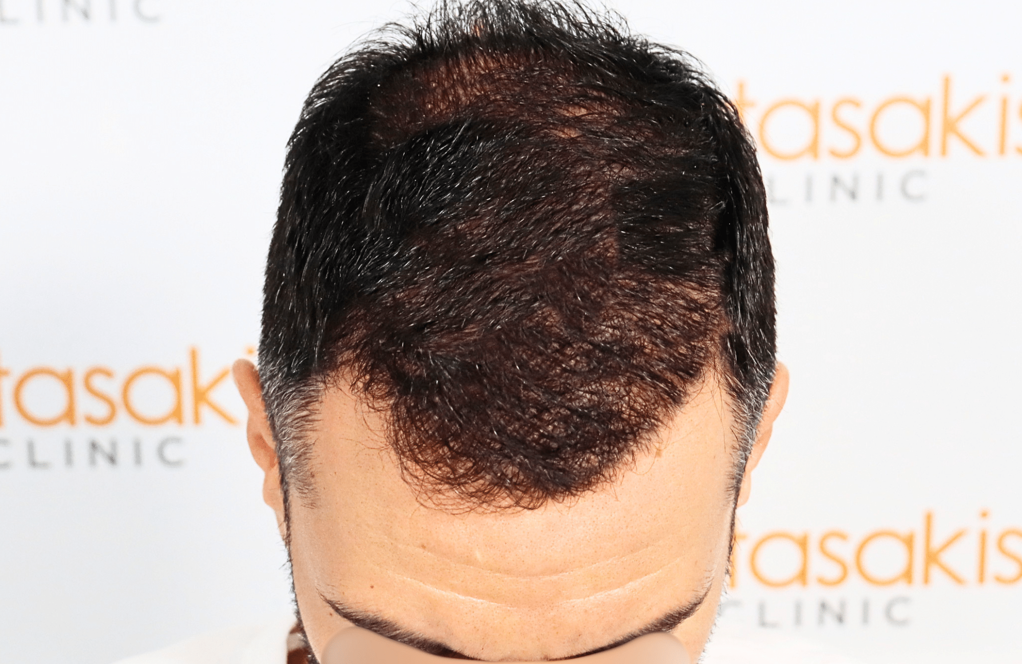 hair transplant result 2600 fus stage5 thickening