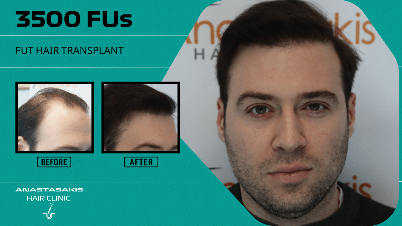 hair transplant result with 3500 follicular units anastasakis hair clinic
