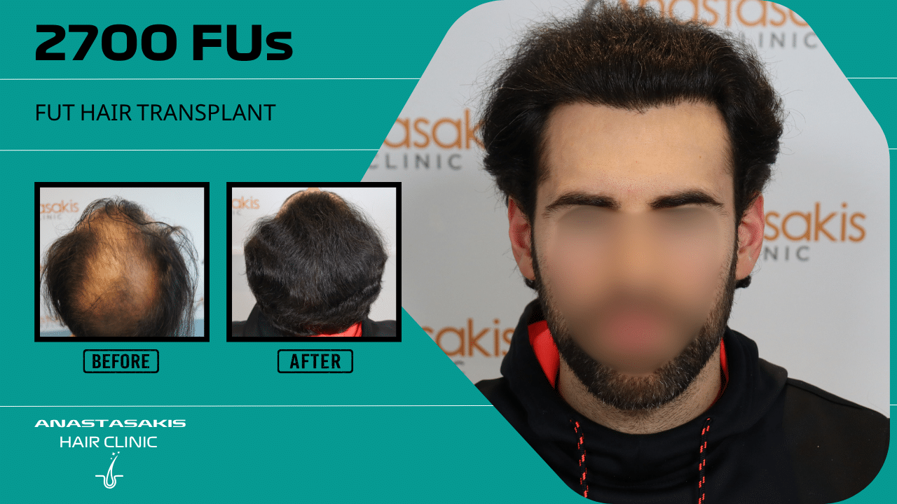 Anastasakis Hair Clinic