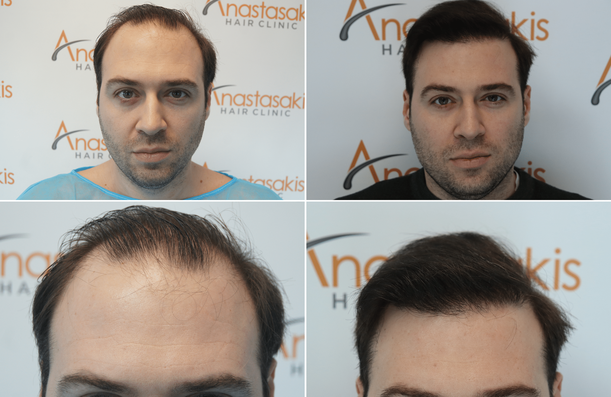 https://www.anastasakishairclinic.gr/portfolio/apotelesma-metamosxefsis-mallion-anastasakis-hair-clinic-563/