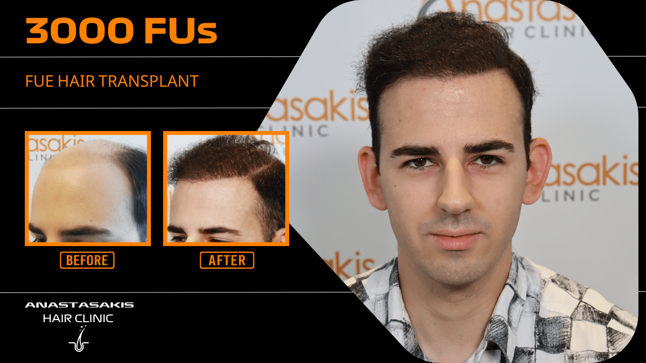 Anastasakis Hair Clinic