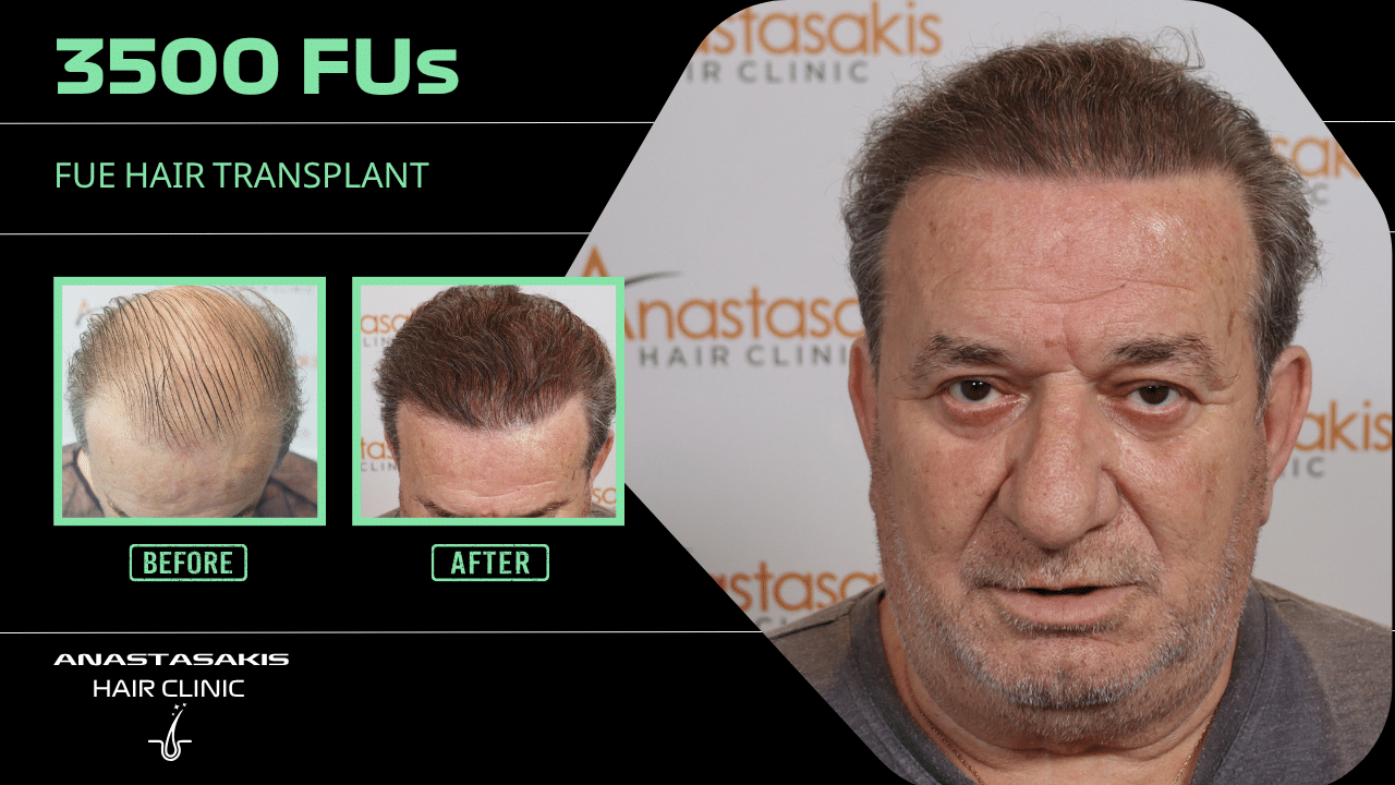 Anastasakis Hair Clinic