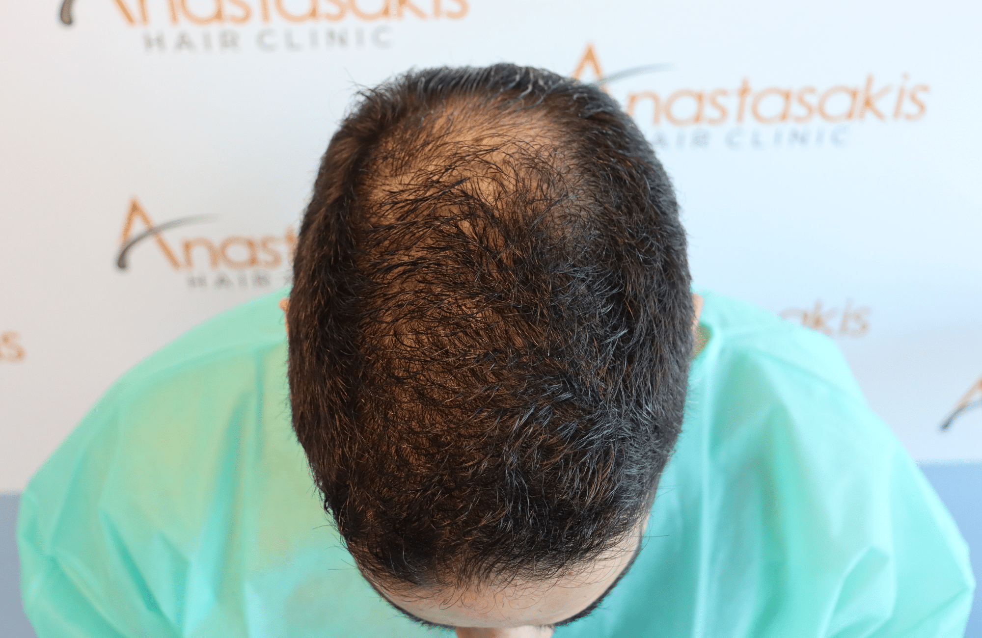 hair transplant result 2300 fus