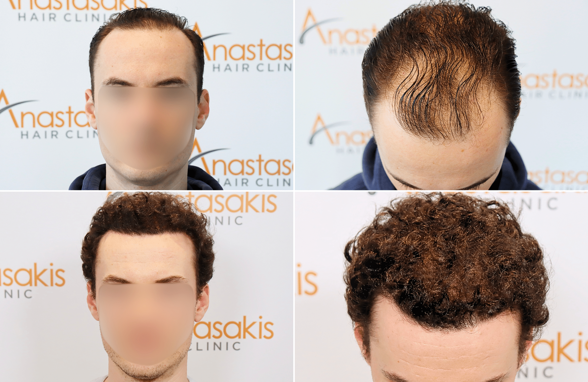 https://www.anastasakishairclinic.gr/portfolio/apotelesma-metamosxefsis-mallion-anastasakis-hair-clinic-67/