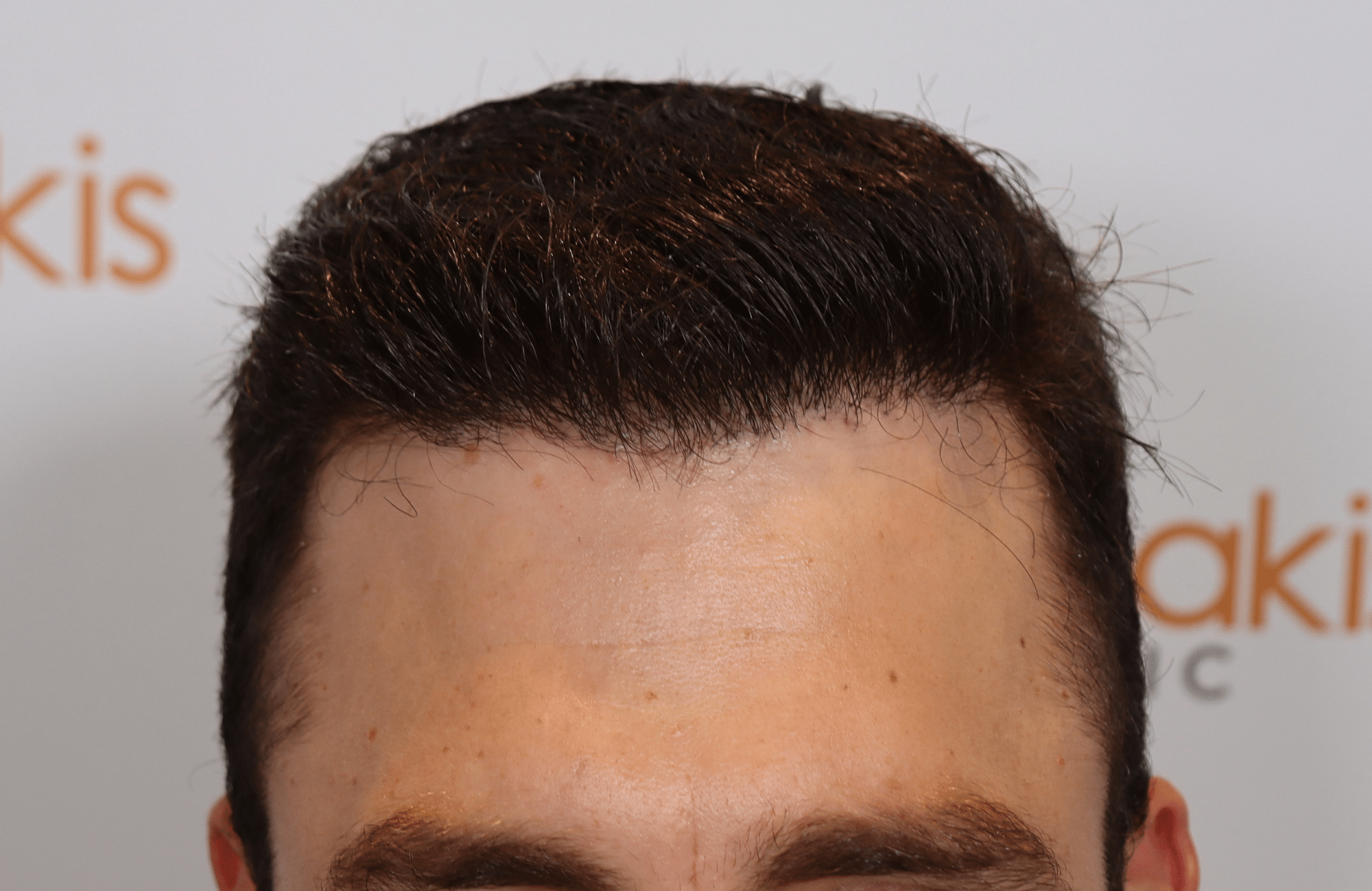 hair transplant result