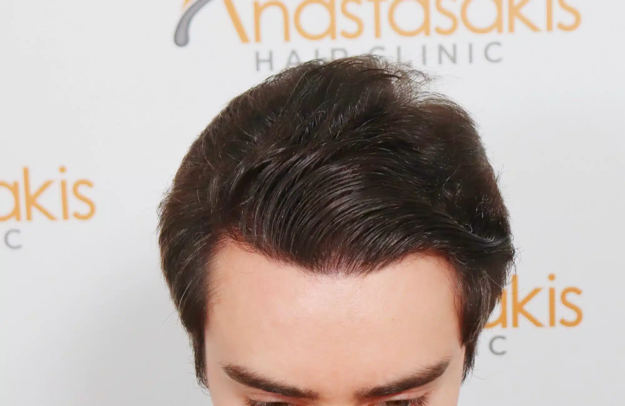 hair transplant 2600 fus