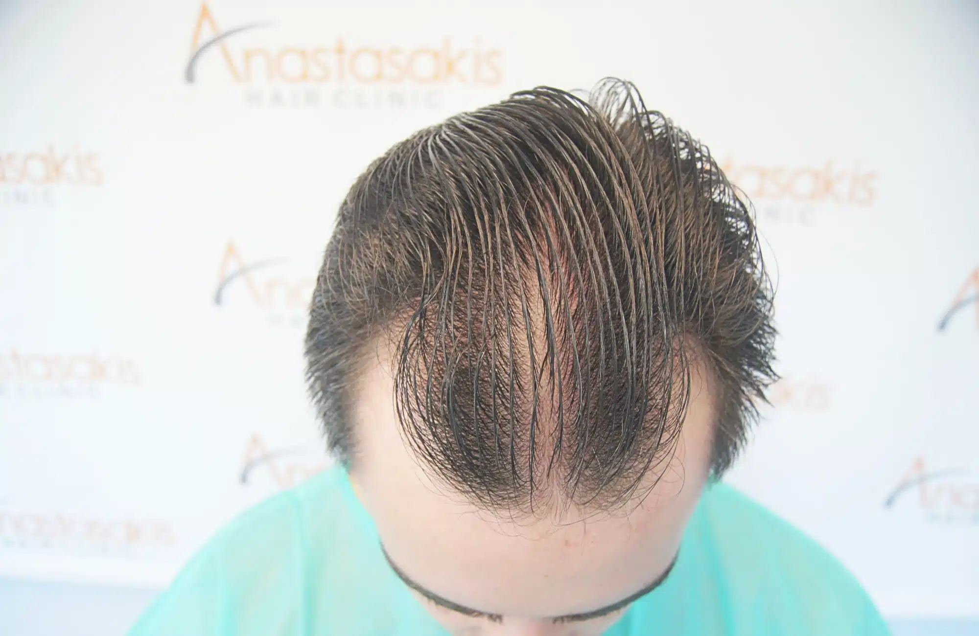 hair transplant 2600 fus